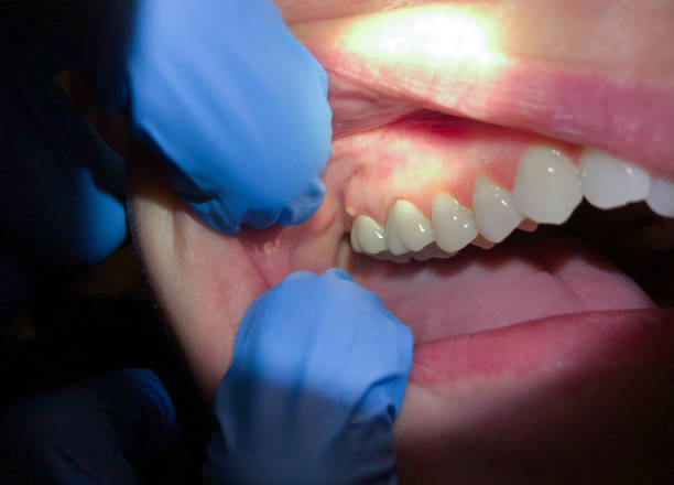 Best Emergency Dental Care for Broken or Chipped Teeth in Pulaski, WI